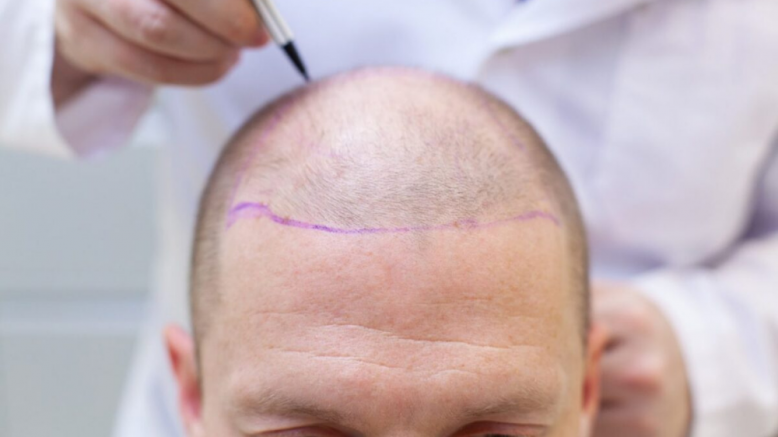 “Saç Ekimi Teknolojisinde Yeni Dönem: DHT Dirençli Saç Ekimi Yöntemi İle Kalıcı Sonuçlar!